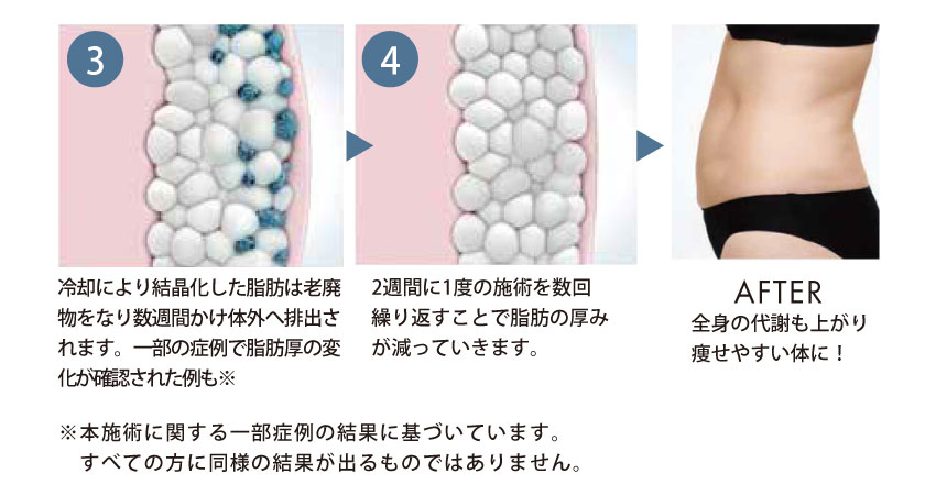 360°脂肪冷却痩身機脂肪冷却 脂肪冷却痩身機器COOL360・ADSS美容機器会社