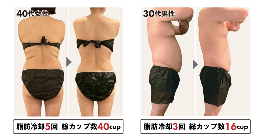 360度　脂肪冷却　強いパワー　業務用　同時稼働 業務用冷却美容機器｜3Dサラウンドクライオ｜フォレストシンフォニー